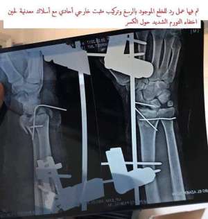 صحة السويس : إجراء جراحة عظام ناجحه (متعددة الخطوات) بمستشفي السويس العام