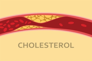 علامات تحذيرية تكشف لك الإصابة بارتفاع الكوليسترول